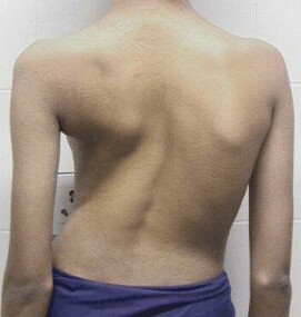 Scoliosis spinal curvature